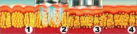 Remodelage du corps et réduction de la cellulite